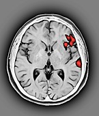 Brain activity in speech production, MRI
