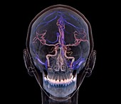 Normal brain blood supply, 3D CT scan