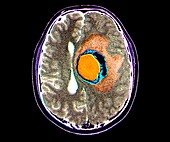 Brain cancer, MRI