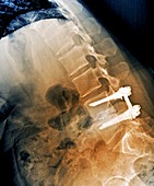 Treatment of spinal disc herniation, X-ray