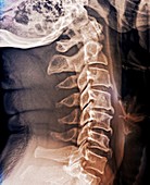 Spinal arthritis, X-ray