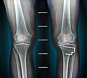 Osteoarthritis of the knee, X-ray