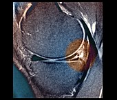 Knee meniscus injury, MRI scan