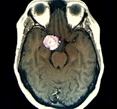 Meningioma brain tumour, MRI scan
