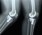 Total knee replacement, X-rays