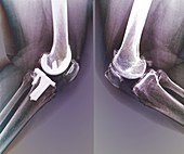 Knee osteoarthritis and total knee replacement, X-rays