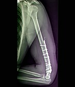 Fixed upper arm fracture, X-ray