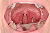 Streptococcal tonsillitis