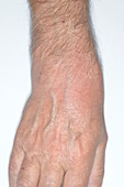 Cellulitis on the wrist
