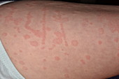 Urticaria rash due to vaccine reaction