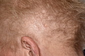 Alopecia hair loss