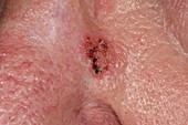 Bowenoid keratosis