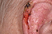 Bowenoid keratosis on an ear