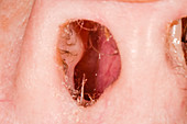 Nasal polyps