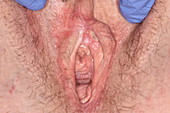 Vulval lichen sclerosus