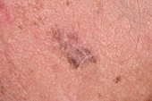 Lentigo maligna melanoma