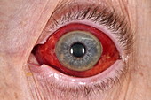 Subconjunctival bleeding due to high blood pressure