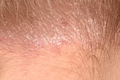 Scalp psoriasis