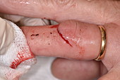 Laceration to finger