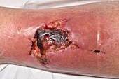 Leg wound following a fall