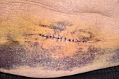 Abdominal wound and bruising