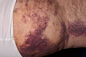 Haematoma on leg following an accident