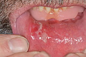 Mouth ulcer inside lower lip