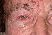 Shingles rash affecting facial nerve