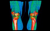 Knee joints and muscles, 3D CT scan