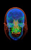 Head and skull, 3D CT scan
