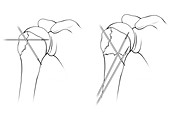 Kirschner wires in shoulder fracture surgery, illustration