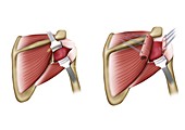 Shoulder joint capsule surgery, illustration