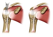 Intramedullary rod shoulder surgery, illustration