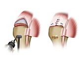 Plate and suture placement in shoulder surgery, illustration