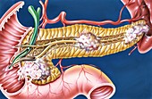 Pancreatic cancers, illustration