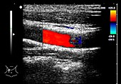 Carotid artery, doppler ultrasound scan