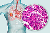 Lung cancer, composite image