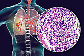 Lung cancer, composite image