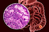 Colon cancer, composite image
