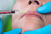 Woman having hyaluronic acid injections