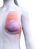 Breast implants, illustration
