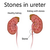 Normal kidney and kidney with stones in ureter, illustration