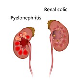 Pyelonephritis and kidney with renal colic, illustration
