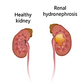 Healthy kidney and renal hydronephrosis, illustration