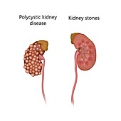 Polycystic disease and kidney with stones, illustration