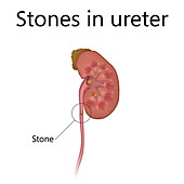 Kidney with stones in ureter, illustration