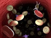 Diseased blood cells, illustration