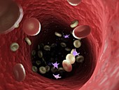 Diseased blood cells, illustration