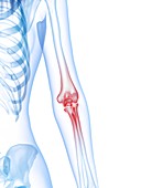 Elbow pain, conceptual illustration