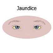 Jaundiced eyes, illustration